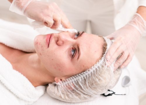 Woman receiving acne scarring treatments
