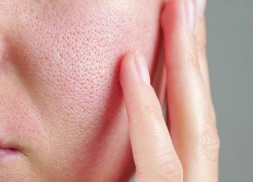 Enlarged pores on a woman's cheek