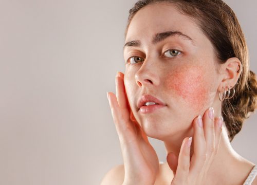 Woman with rosacea on her cheek