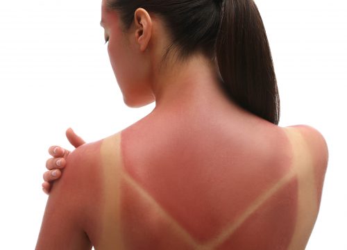 Woman with sun damage to her back