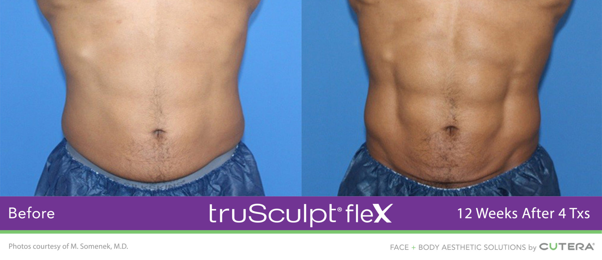 Muscle Toning & Firming with TruFlex - Dr T Aesthetics
