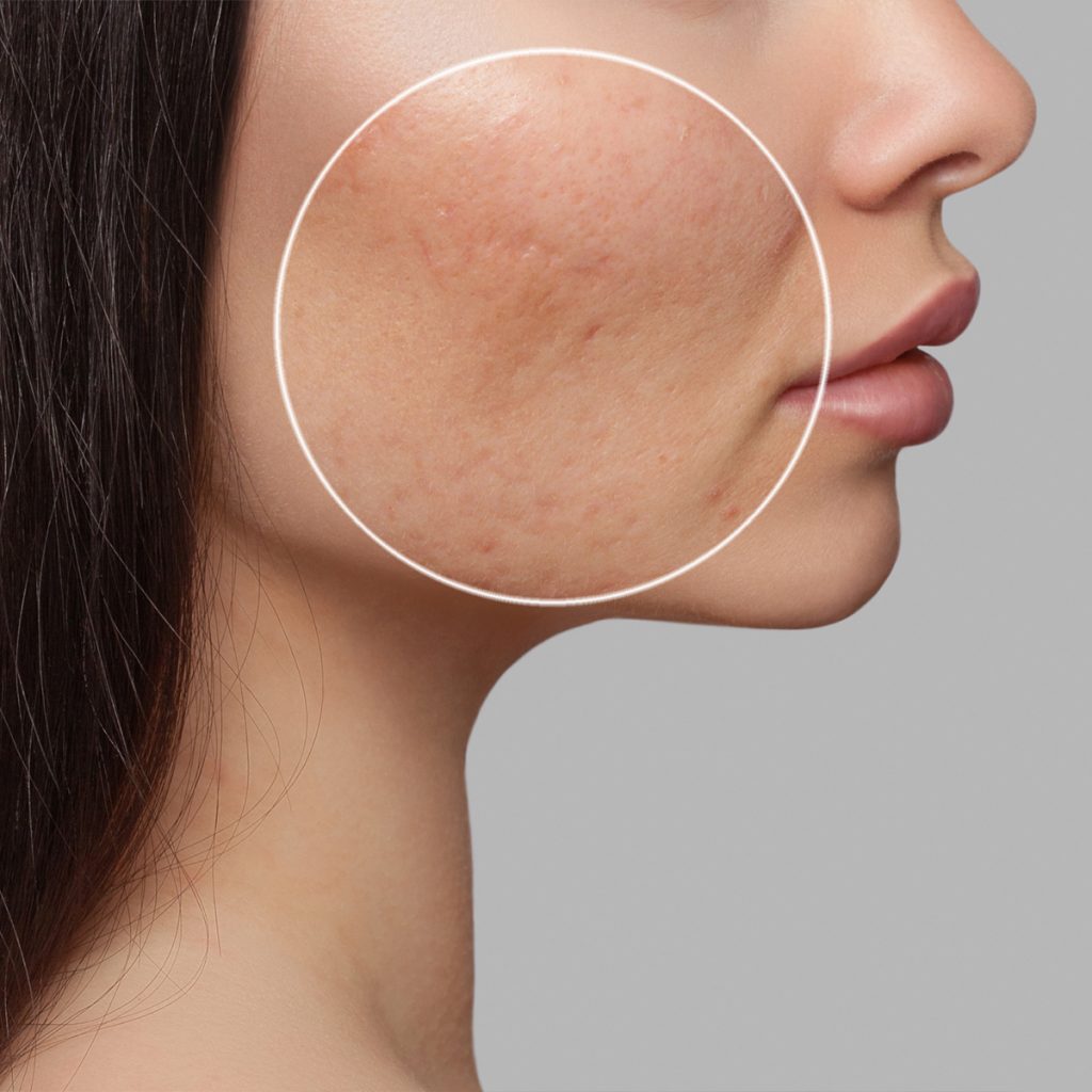 Close up on acne scars on a woman's face