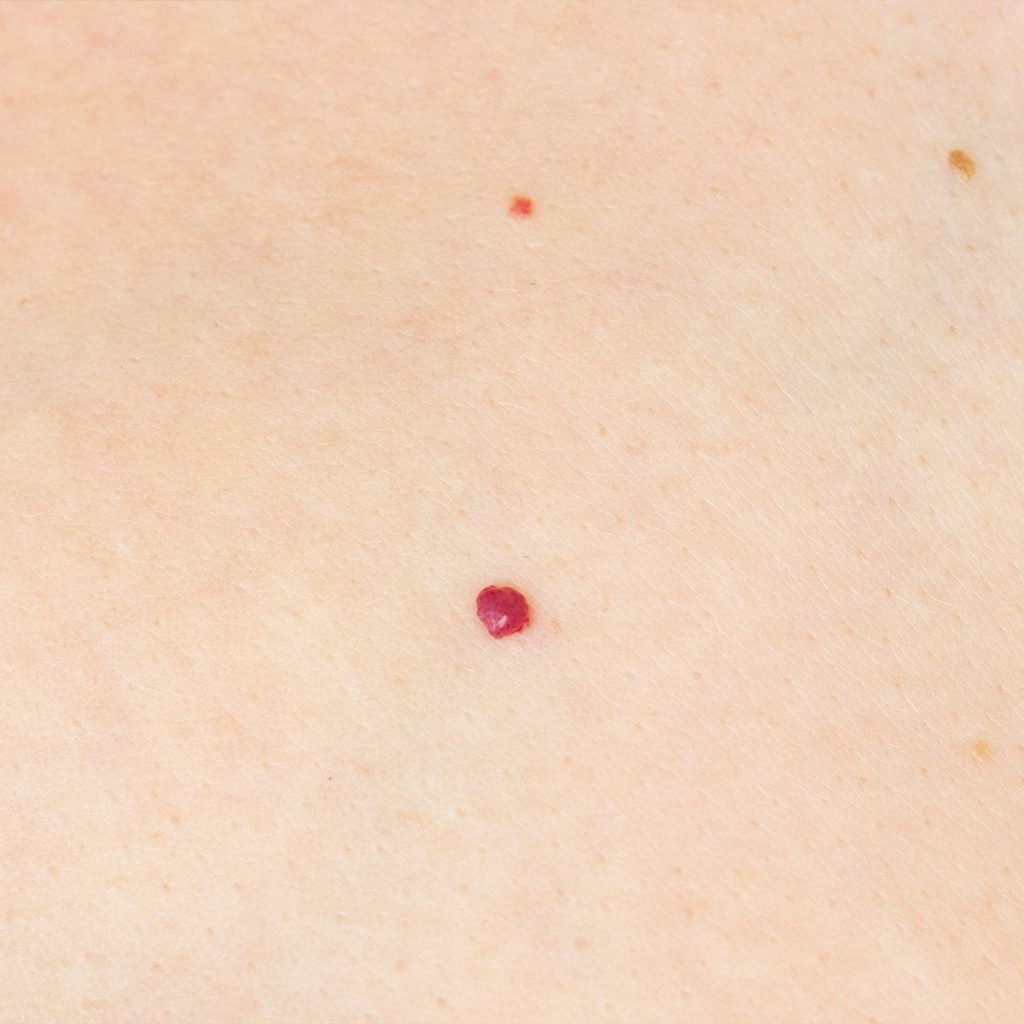 Angiomas on a person's skin