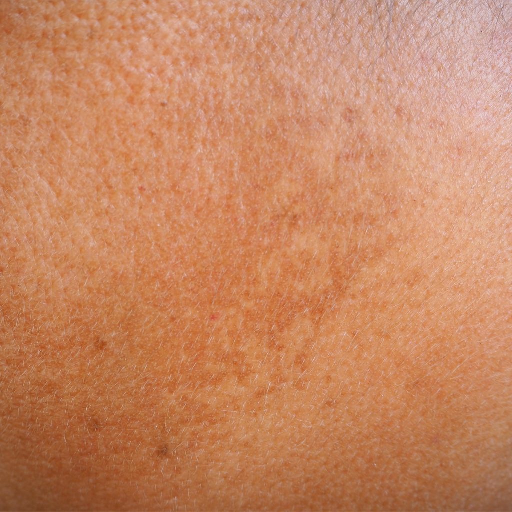 Close-up on hyperpigmentation
