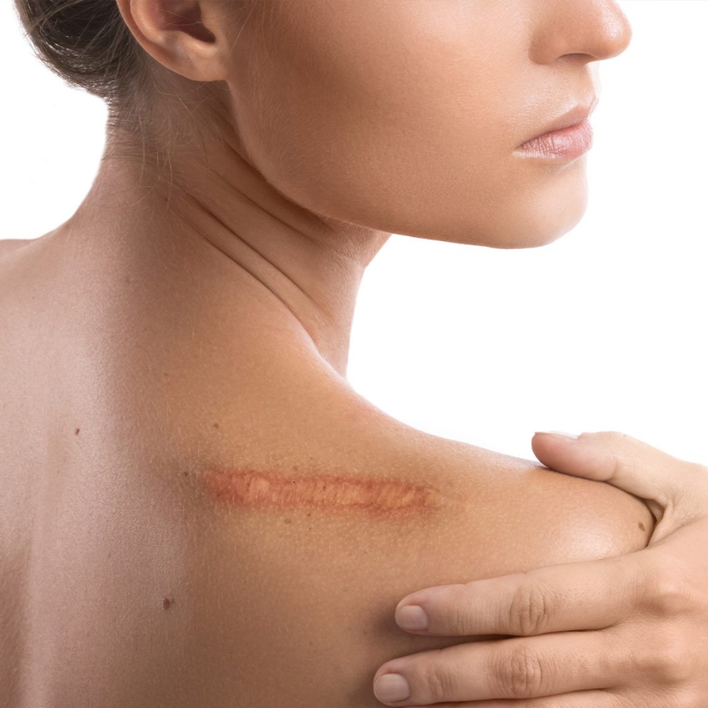 Scar on a woman's shoulder