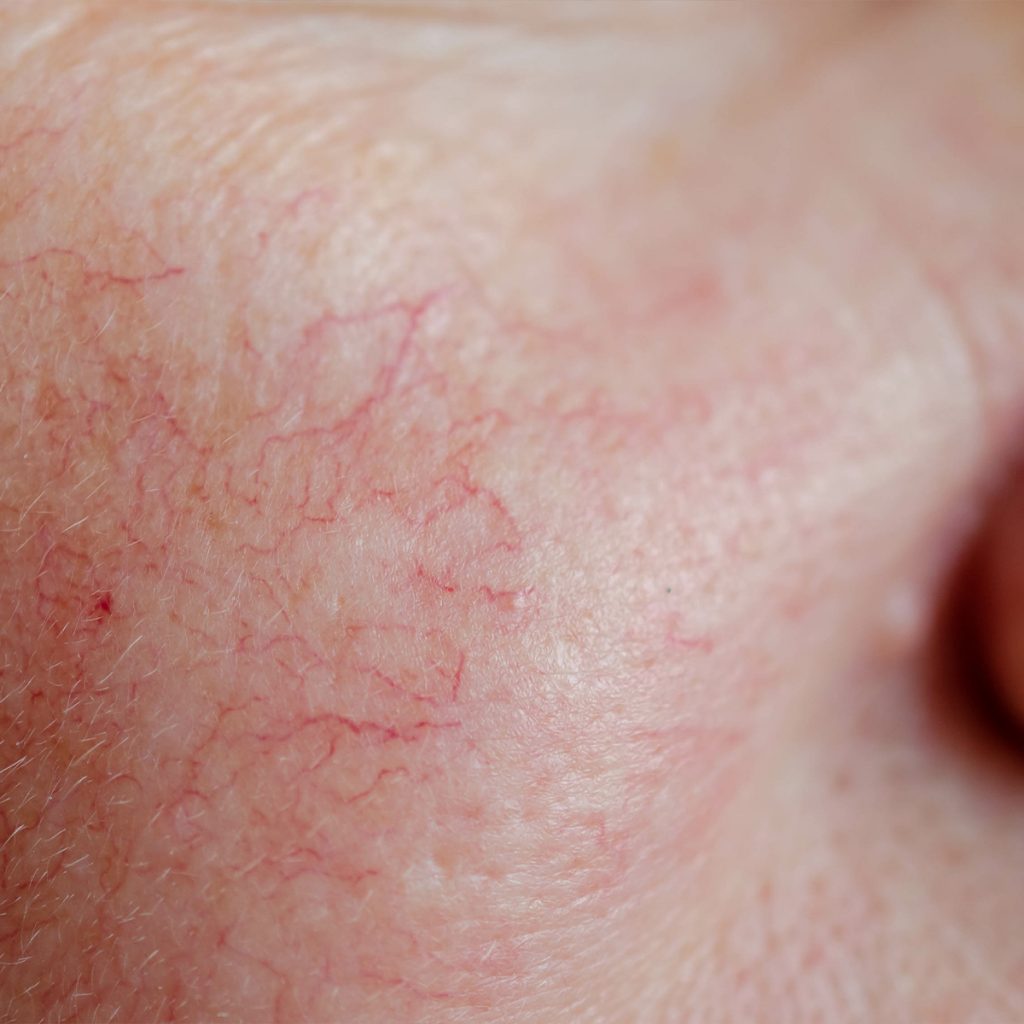 Spider veins on a person's face