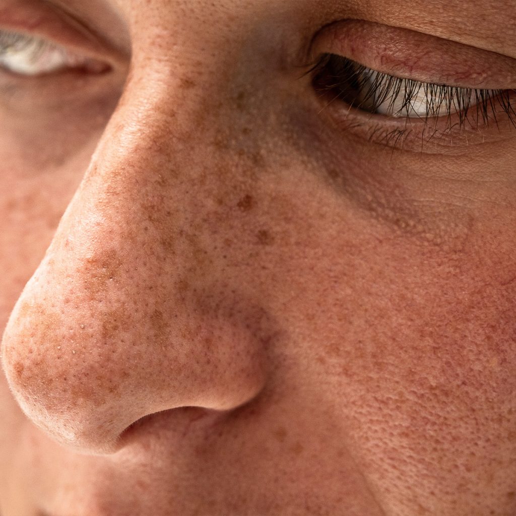 Sun damage on a woman's nose